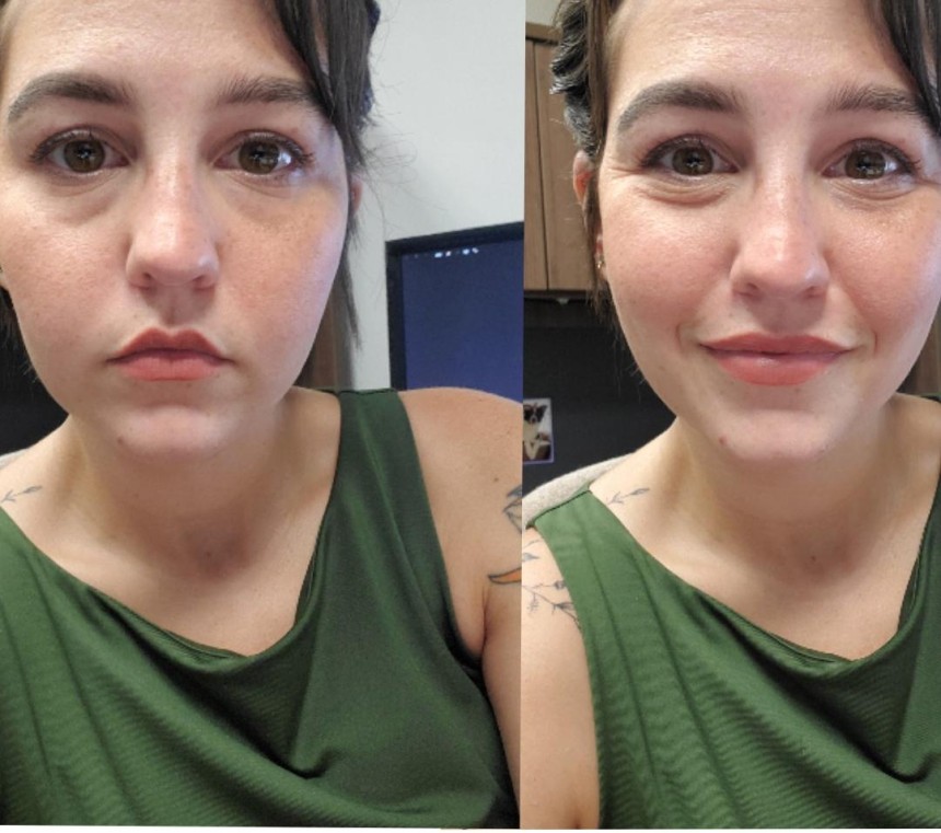 My Undereye puffiness was finally addressed with the help of a powerful eyeliner.